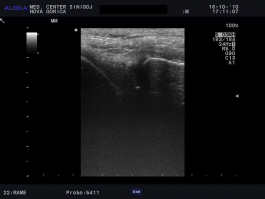 Ultrazvok kolena - možna poškodba meniska